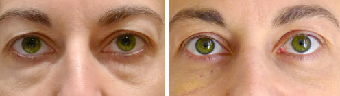 blepharoplastie-photo-avant-apres