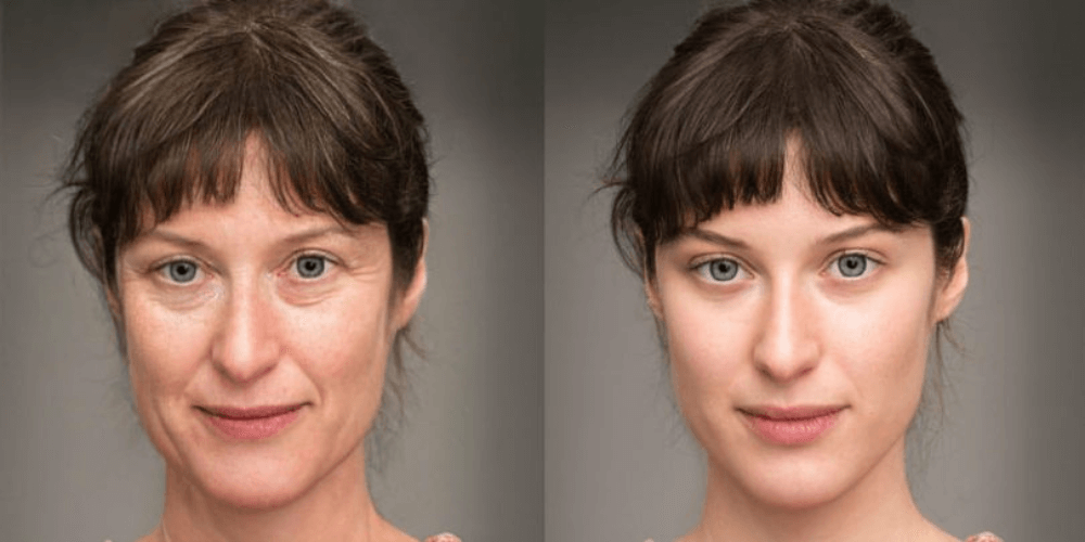 Comparaison avant et après un lifting cervico-facial