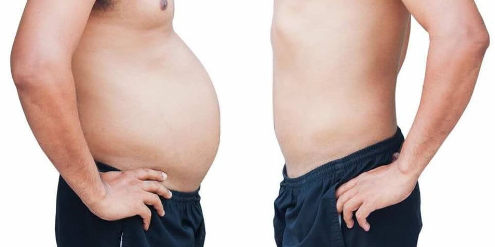 Avant et après la liposuccion