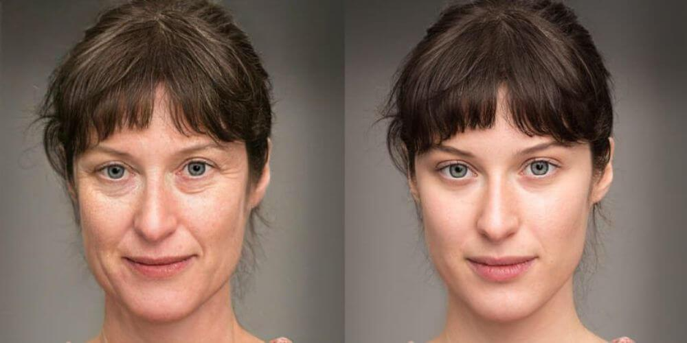 Avant et après le lifting du visage