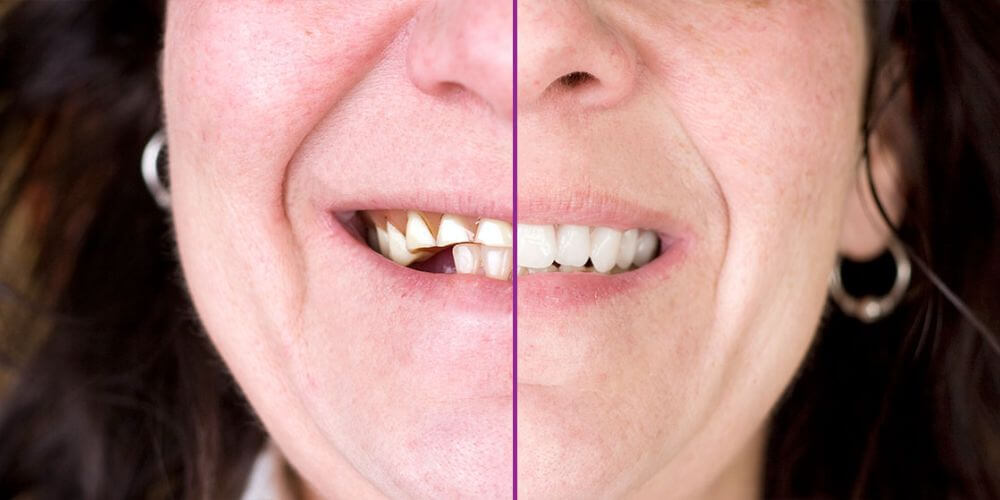 Avant et après une implantation dentaire Tunisie
