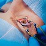 Cataracte chirurgie