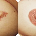 dépigmentation de l'aréole mammaire menopause