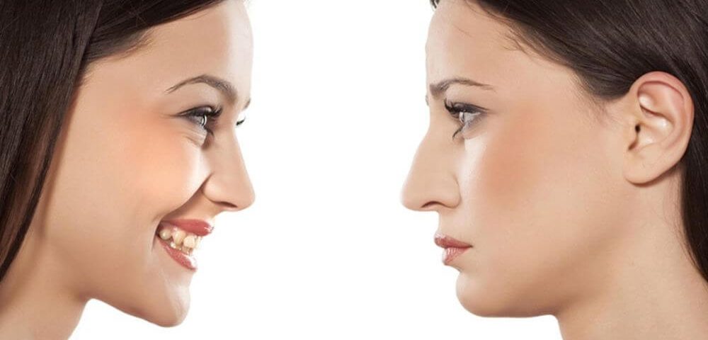 Rhinoplastie