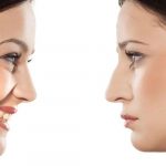 Rhinoplastie