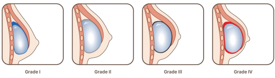 Stades de la contracture capsulaire autour des implants mammaires